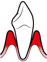 paradontite