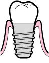 peri-implantite